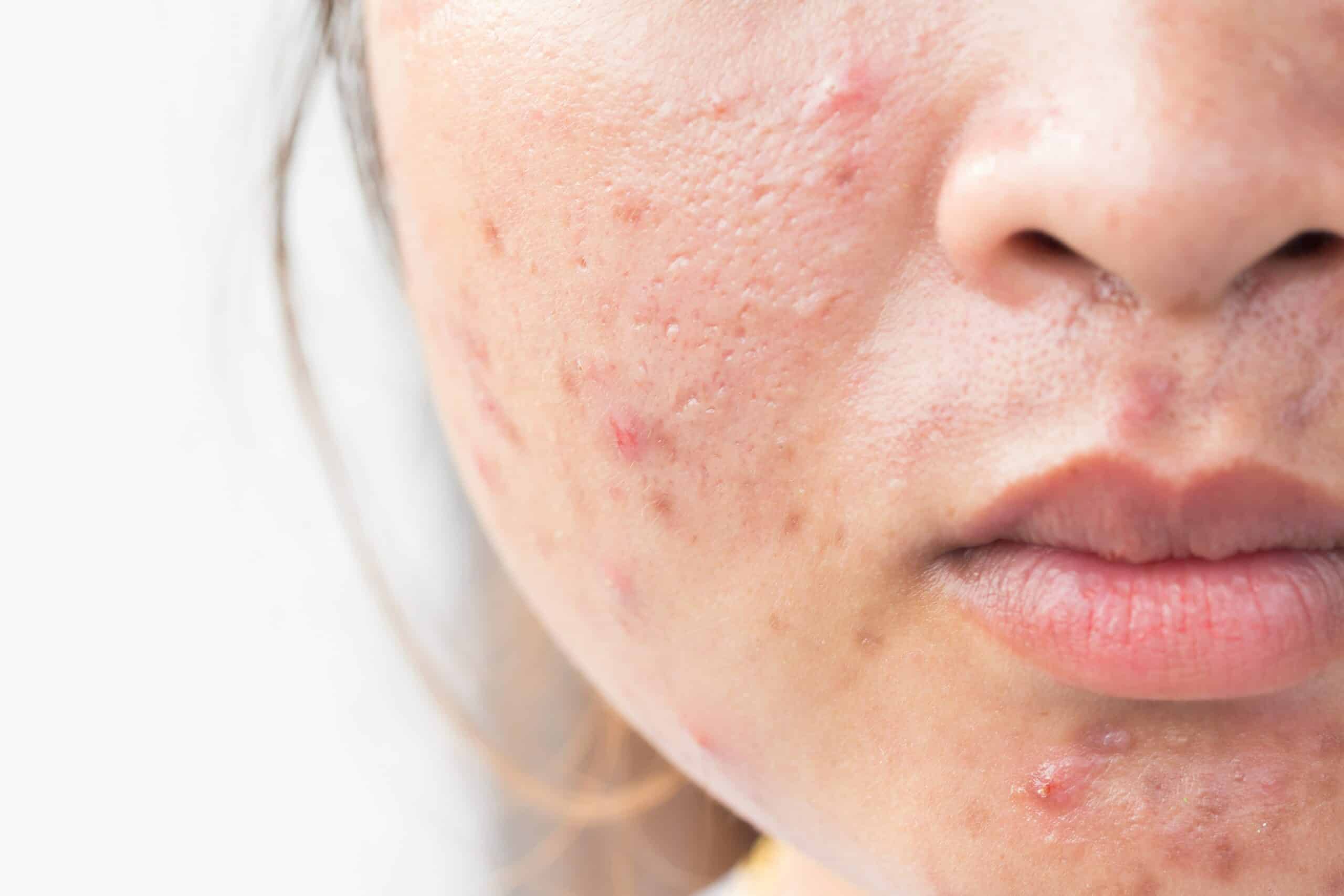 Pico Laser For Acne Scar Removal: Better And Safer? | Dream Plastic Surgery