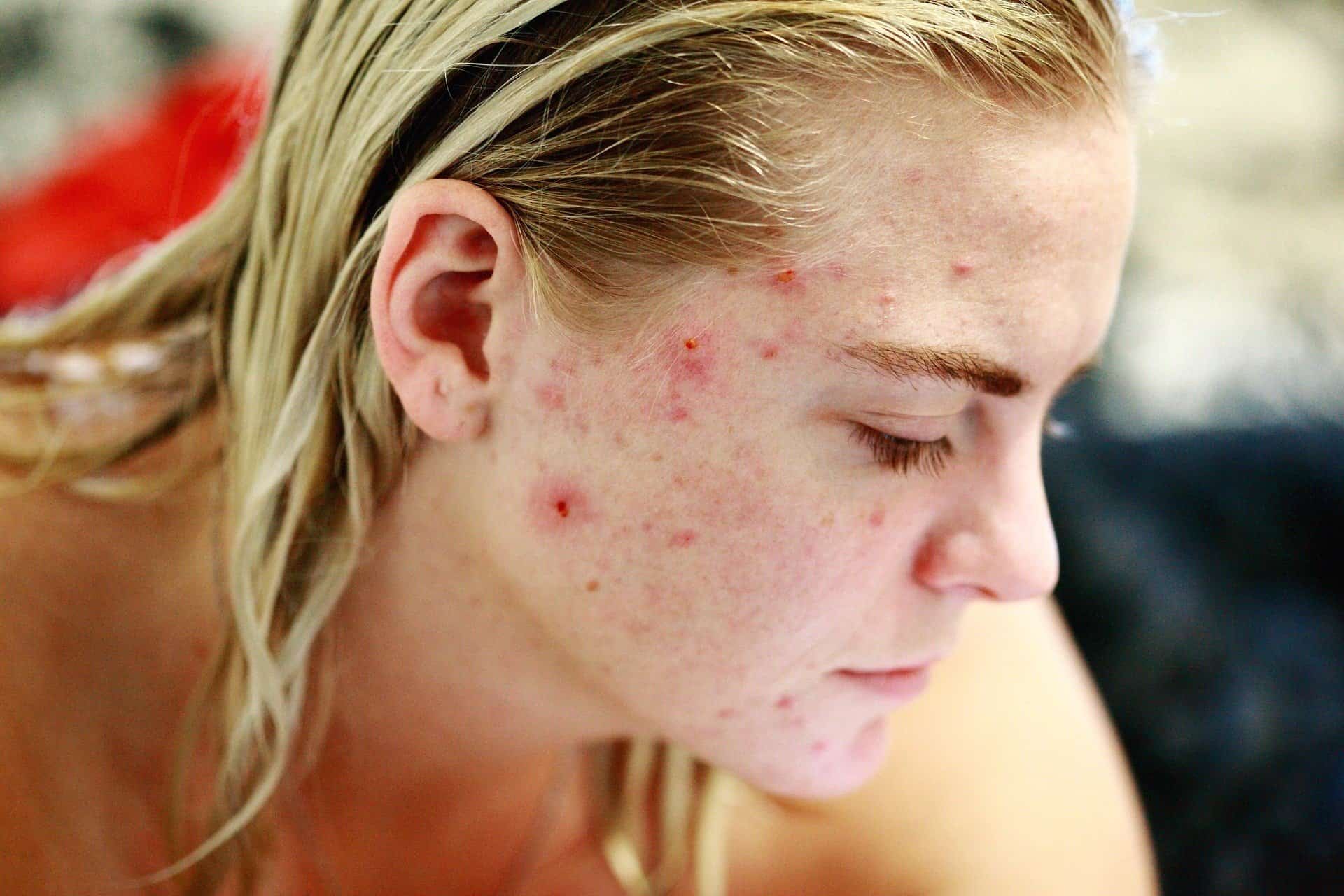 I m A Teenager Why Is My Acne Worse Than My Friends Stratum Clinics