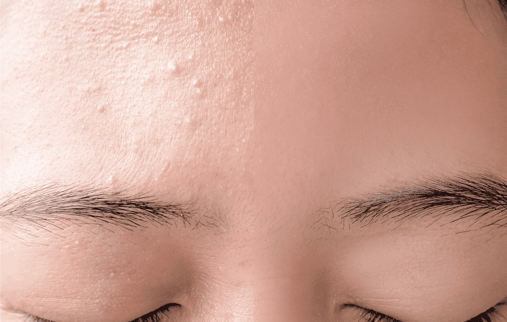 Microneedling for Acne Scars: Effectiveness, Side Effects, and Costs -  Stratum Clinics