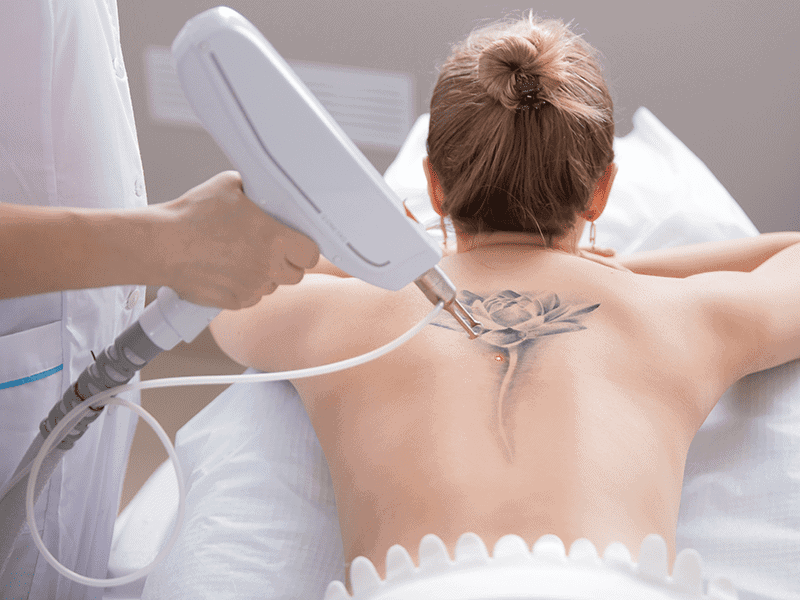 Pain Relief for Tattoo Removal
