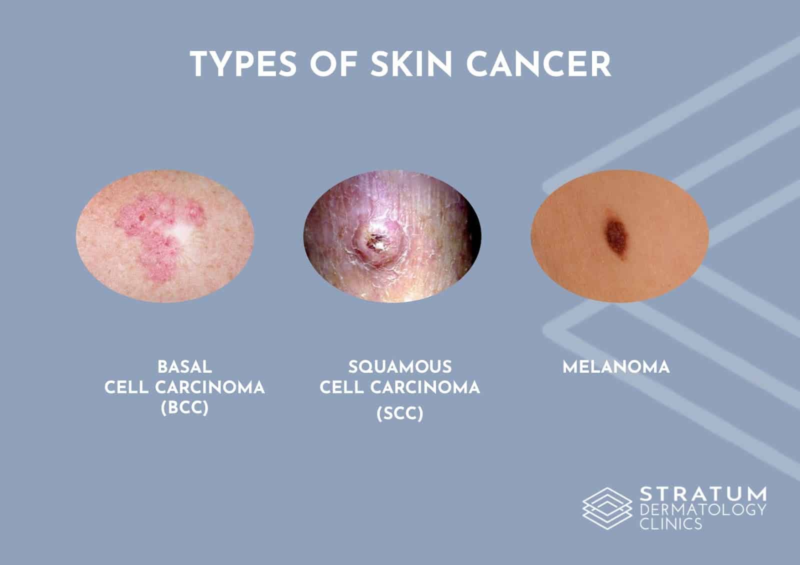 What are the common types of skin cancer? - Stratum Clinics