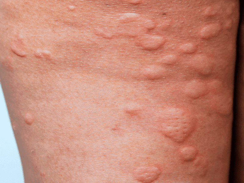 Hives vs. rash: Pictures, differences, and symptoms