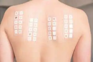 skin allergy patch testing