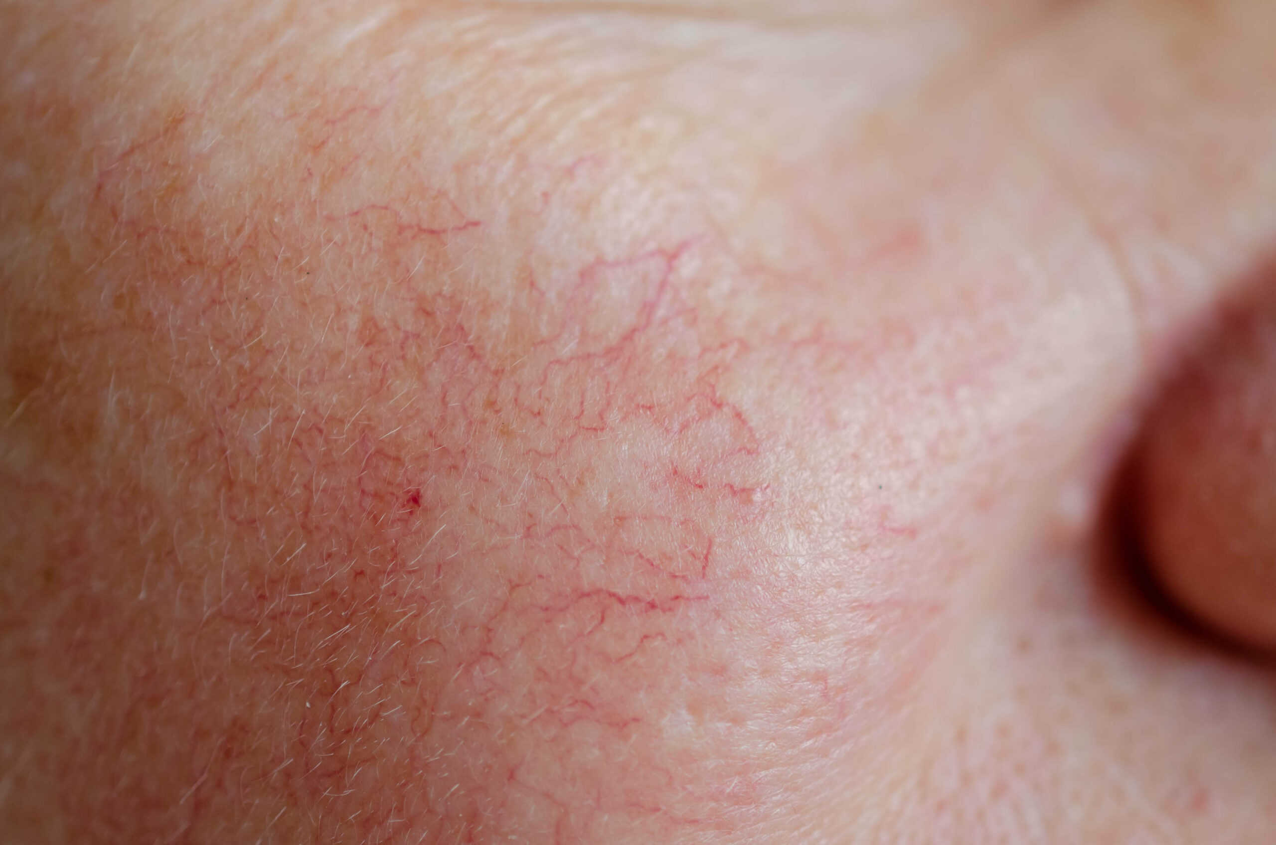 spider-veins-rosacea-and-thread-vein-removal-stratum-clinics