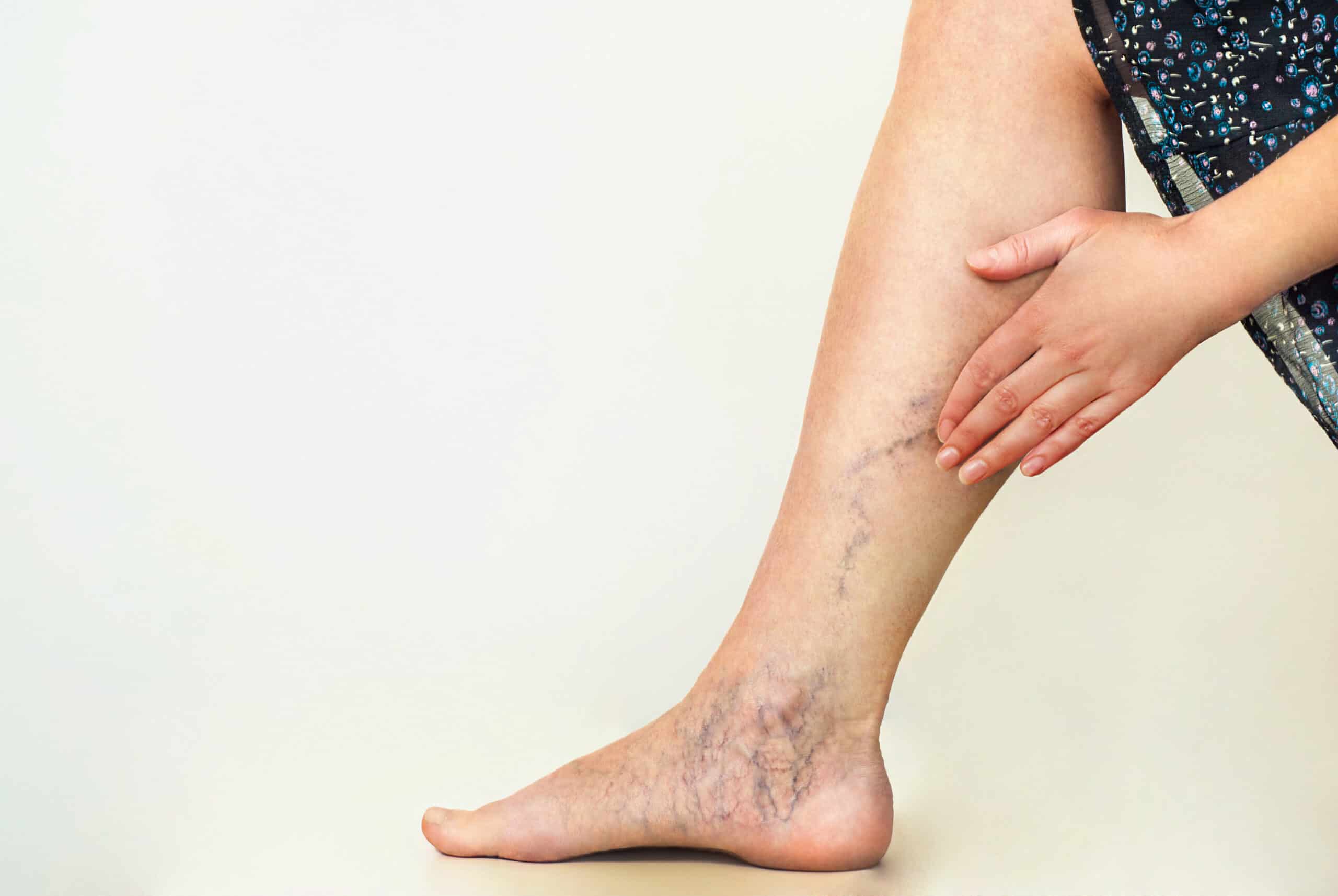How to Treat Varicose Veins — Dermatologist Advice and