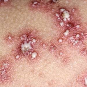 psoriasis photos