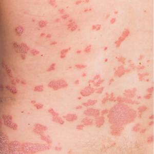 psoriasis pictures