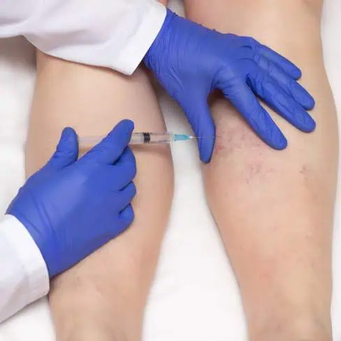 sclerotherapy before and after