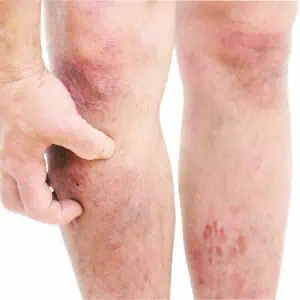 eczema on legs images