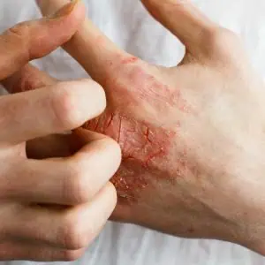 eczema skin rash images