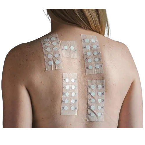 SKIN ALLERGY PATCH TEST