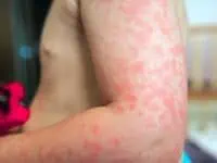 what does skin allergy look like