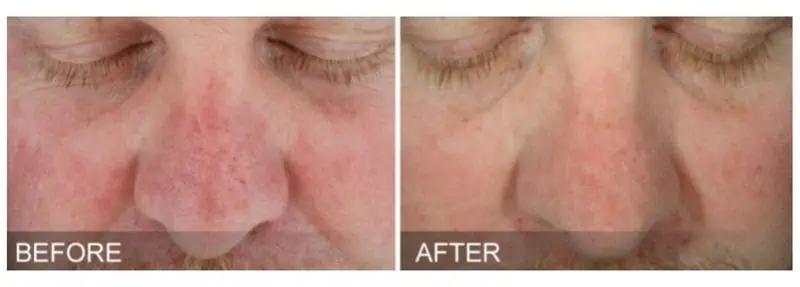 Hydrafacial Before and after - Sun damage​