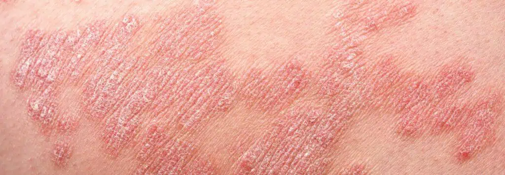 dermatitis eczema